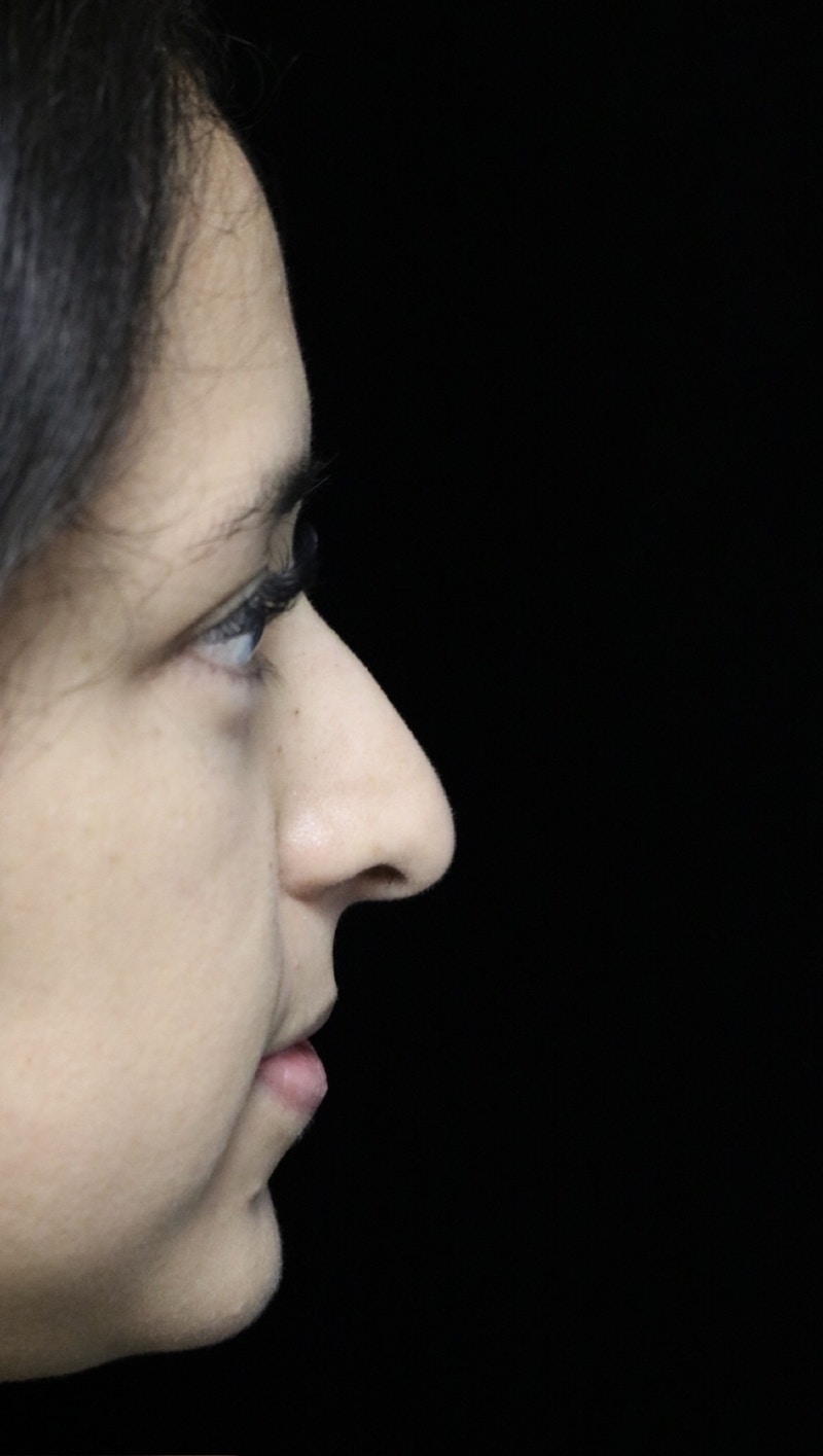 Beverly Hills Rhinoplasty Before & After Gallery - Patient 220247 - Image 1 Dr. Deepak Raj Dugar