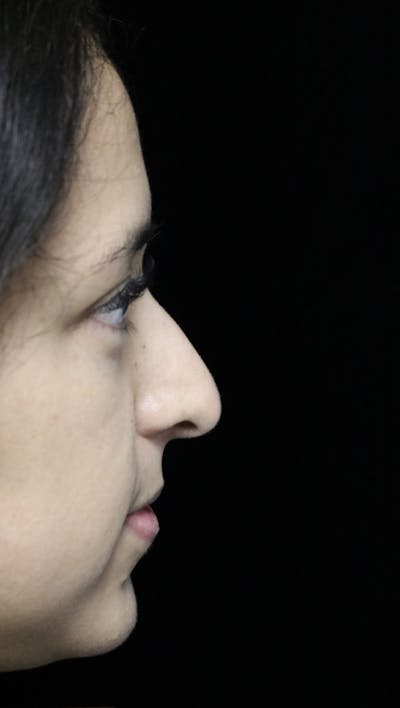 Beverly Hills Rhinoplasty Before & After Gallery - Patient 220247 - Image 1 Dr. Deepak Raj Dugar