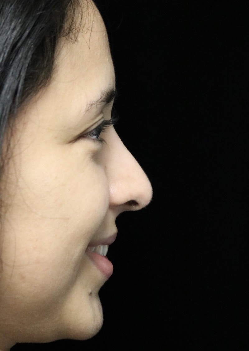 Beverly Hills Rhinoplasty Before & After Gallery - Patient 220247 - Image 12 Dr. Deepak Raj Dugar