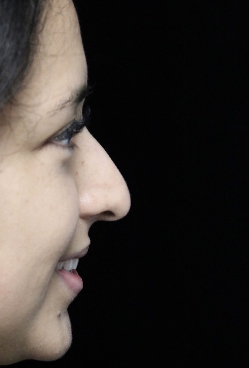 Beverly Hills Rhinoplasty Before & After Gallery - Patient 220247 - Image 11 Dr. Deepak Raj Dugar