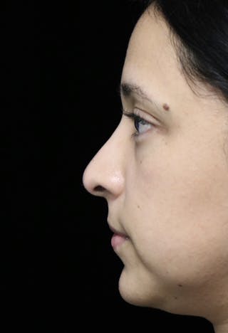Beverly Hills Rhinoplasty Before & After Gallery - Patient 220247 - Image 14 Dr. Deepak Raj Dugar