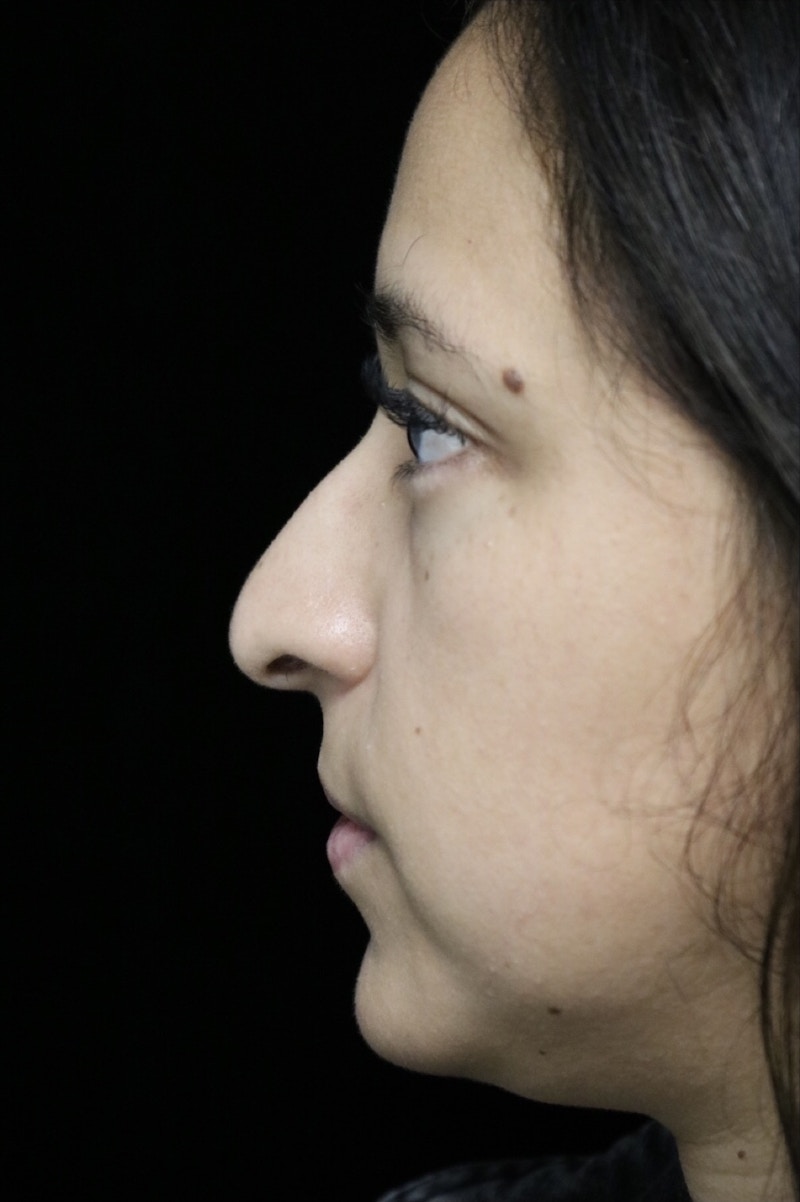 Beverly Hills Rhinoplasty Before & After Gallery - Patient 220247 - Image 13 Dr. Deepak Raj Dugar