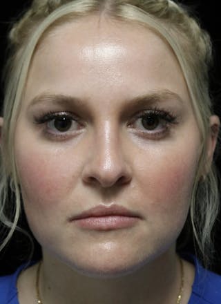 Beverly Hills Rhinoplasty Before & After Gallery - Patient 238345 - Image 4 Dr. Deepak Raj Dugar