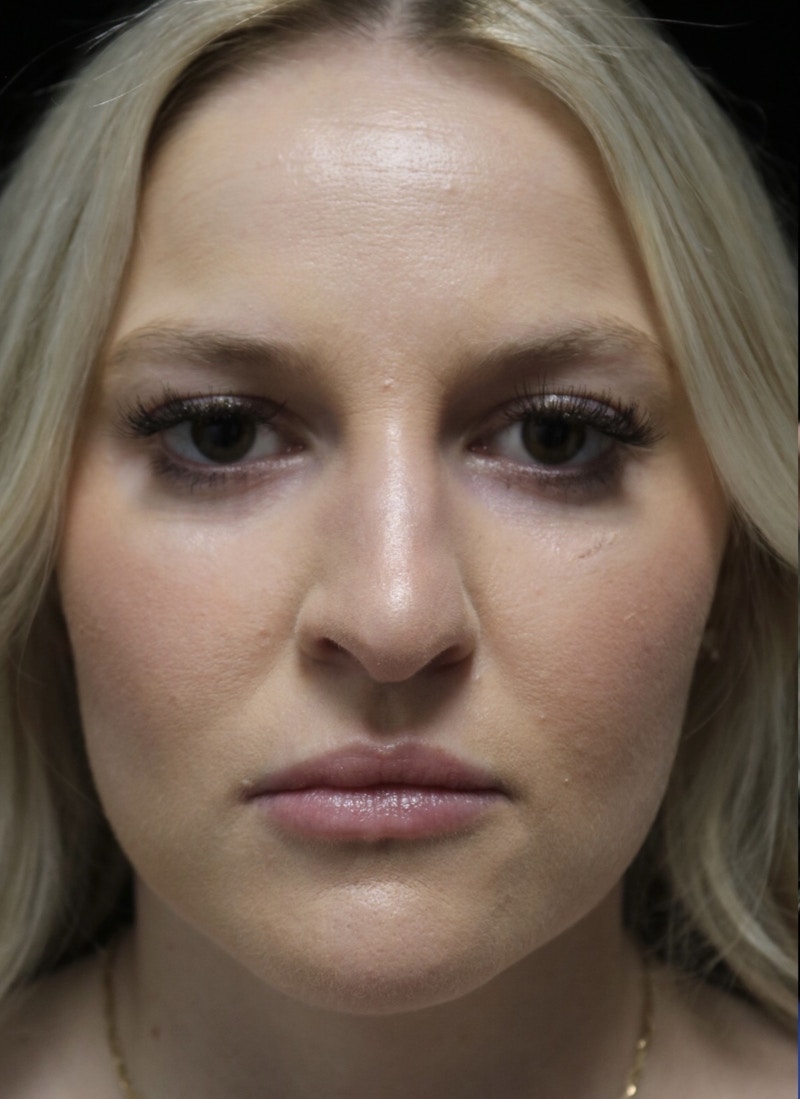 Beverly Hills Rhinoplasty Before & After Gallery - Patient 238345 - Image 3 Dr. Deepak Raj Dugar