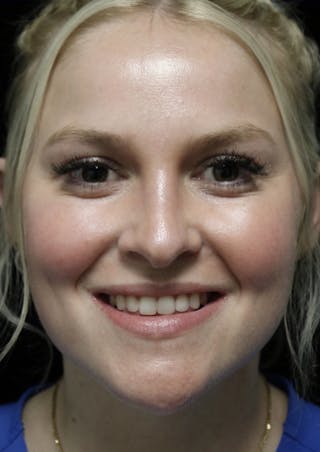 Beverly Hills Rhinoplasty Before & After Gallery - Patient 238345 - Image 6 Dr. Deepak Raj Dugar