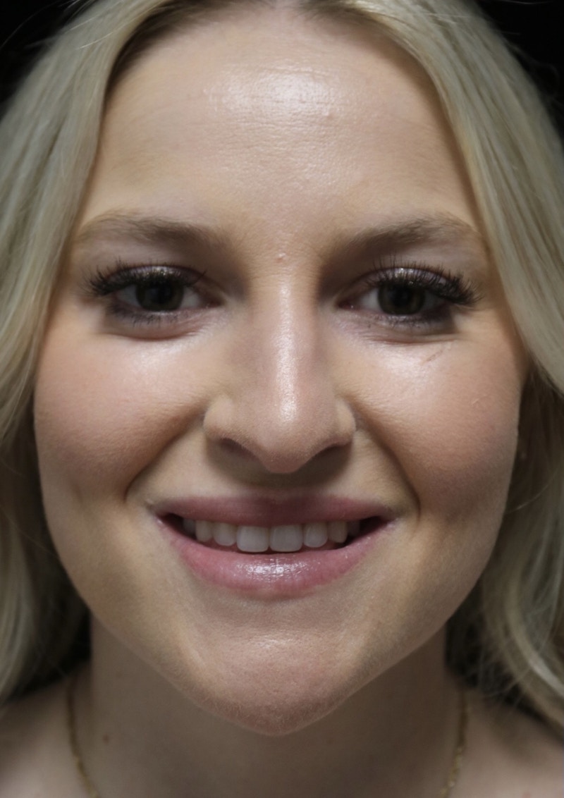 Beverly Hills Rhinoplasty Before & After Gallery - Patient 238345 - Image 5 Dr. Deepak Raj Dugar