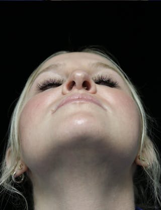 Beverly Hills Rhinoplasty Before & After Gallery - Patient 238345 - Image 8 Dr. Deepak Raj Dugar