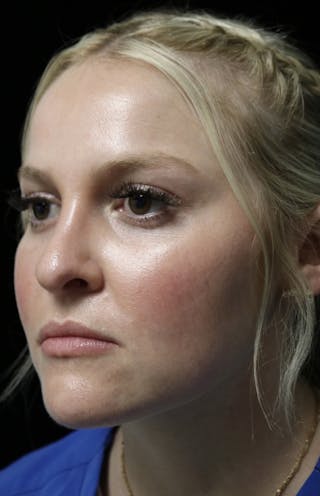 Beverly Hills Rhinoplasty Before & After Gallery - Patient 238345 - Image 10 Dr. Deepak Raj Dugar