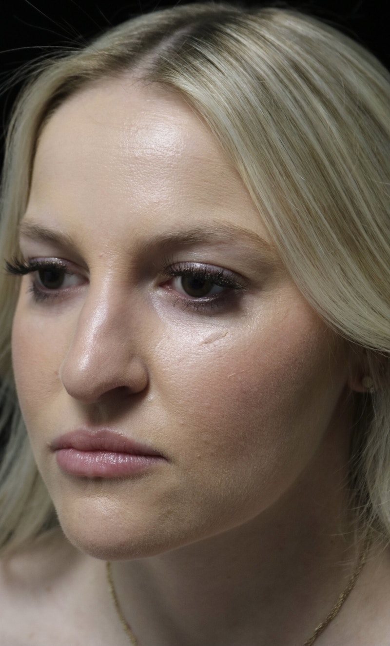 Beverly Hills Rhinoplasty Before & After Gallery - Patient 238345 - Image 9 Dr. Deepak Raj Dugar