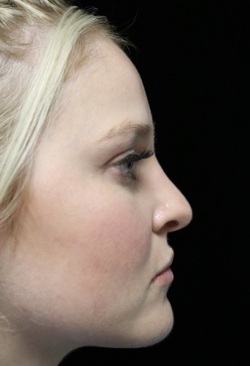 Beverly Hills Rhinoplasty Before & After Gallery - Patient 238345 - Image 2 Dr. Deepak Raj Dugar