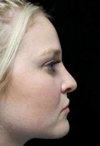Beverly Hills Rhinoplasty Before & After Gallery - Patient 238345 - Image 2 Dr. Deepak Raj Dugar