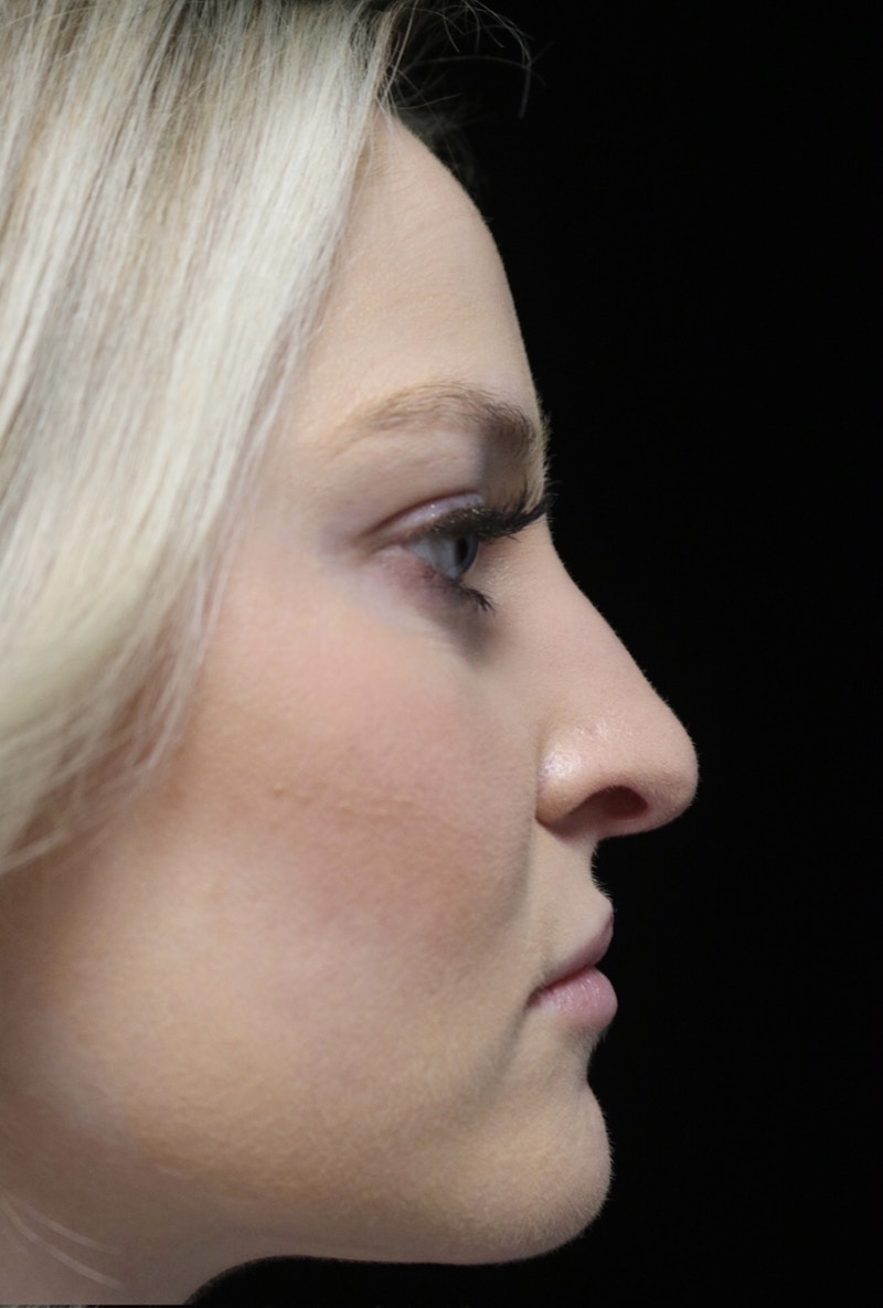 Beverly Hills Rhinoplasty Before & After Gallery - Patient 238345 - Image 1 Dr. Deepak Raj Dugar