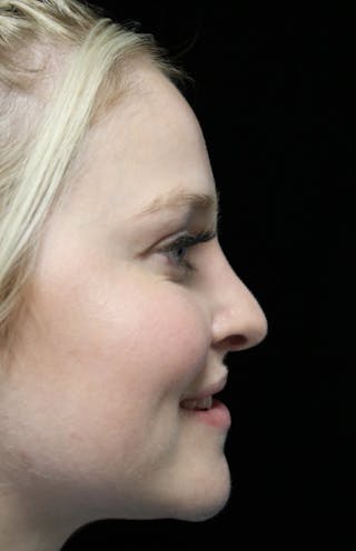 Beverly Hills Rhinoplasty Before & After Gallery - Patient 238345 - Image 12 Dr. Deepak Raj Dugar