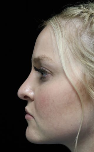 Beverly Hills Rhinoplasty Before & After Gallery - Patient 238345 - Image 14 Dr. Deepak Raj Dugar