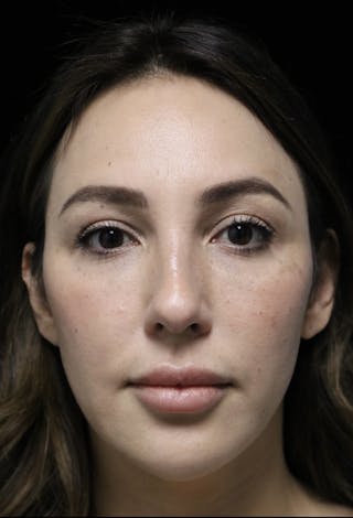 Beverly Hills Rhinoplasty Before & After Gallery - Patient 154581 - Image 4 Dr. Deepak Raj Dugar