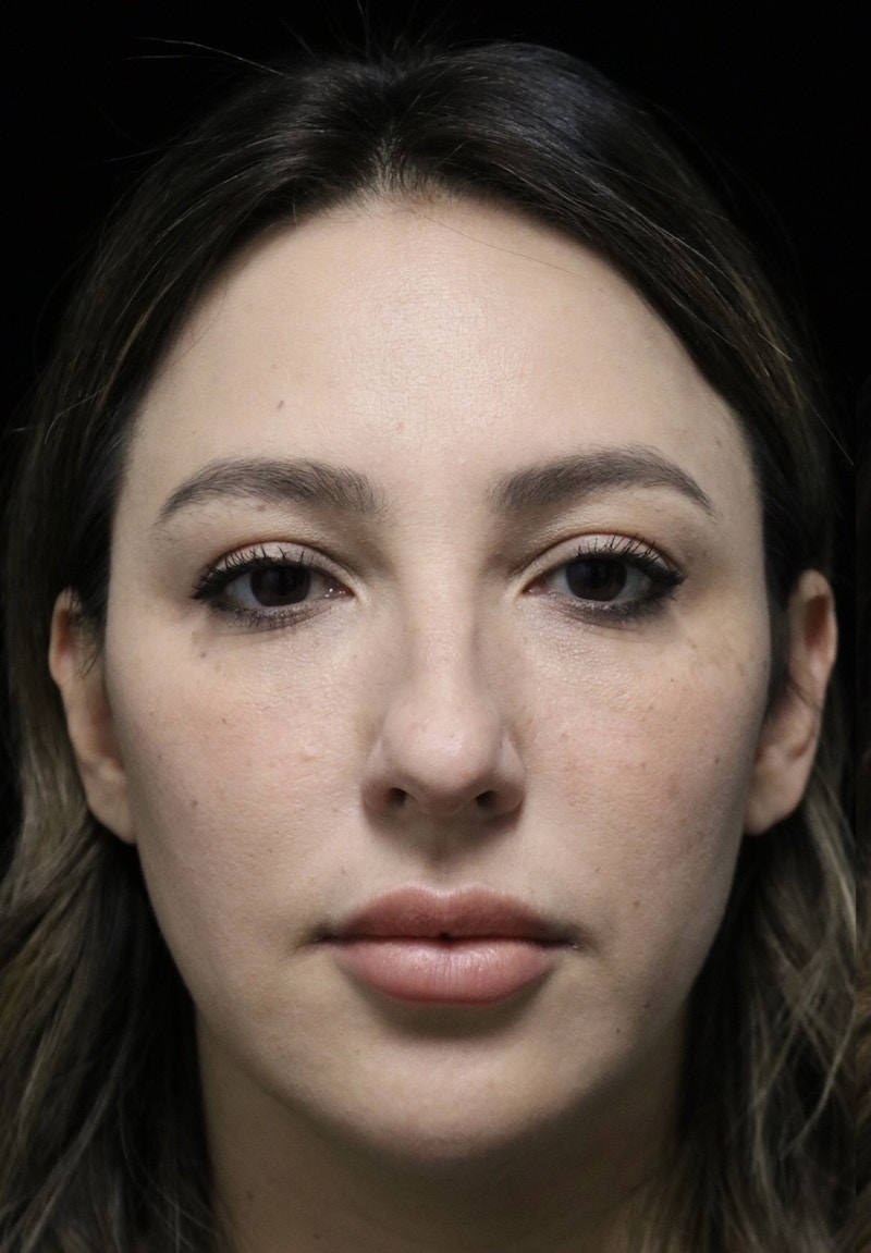 Beverly Hills Rhinoplasty Before & After Gallery - Patient 154581 - Image 3 Dr. Deepak Raj Dugar