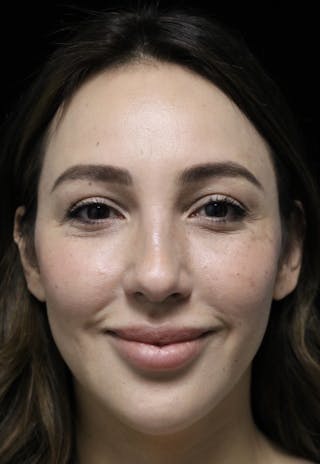 Beverly Hills Rhinoplasty Before & After Gallery - Patient 154581 - Image 6 Dr. Deepak Raj Dugar