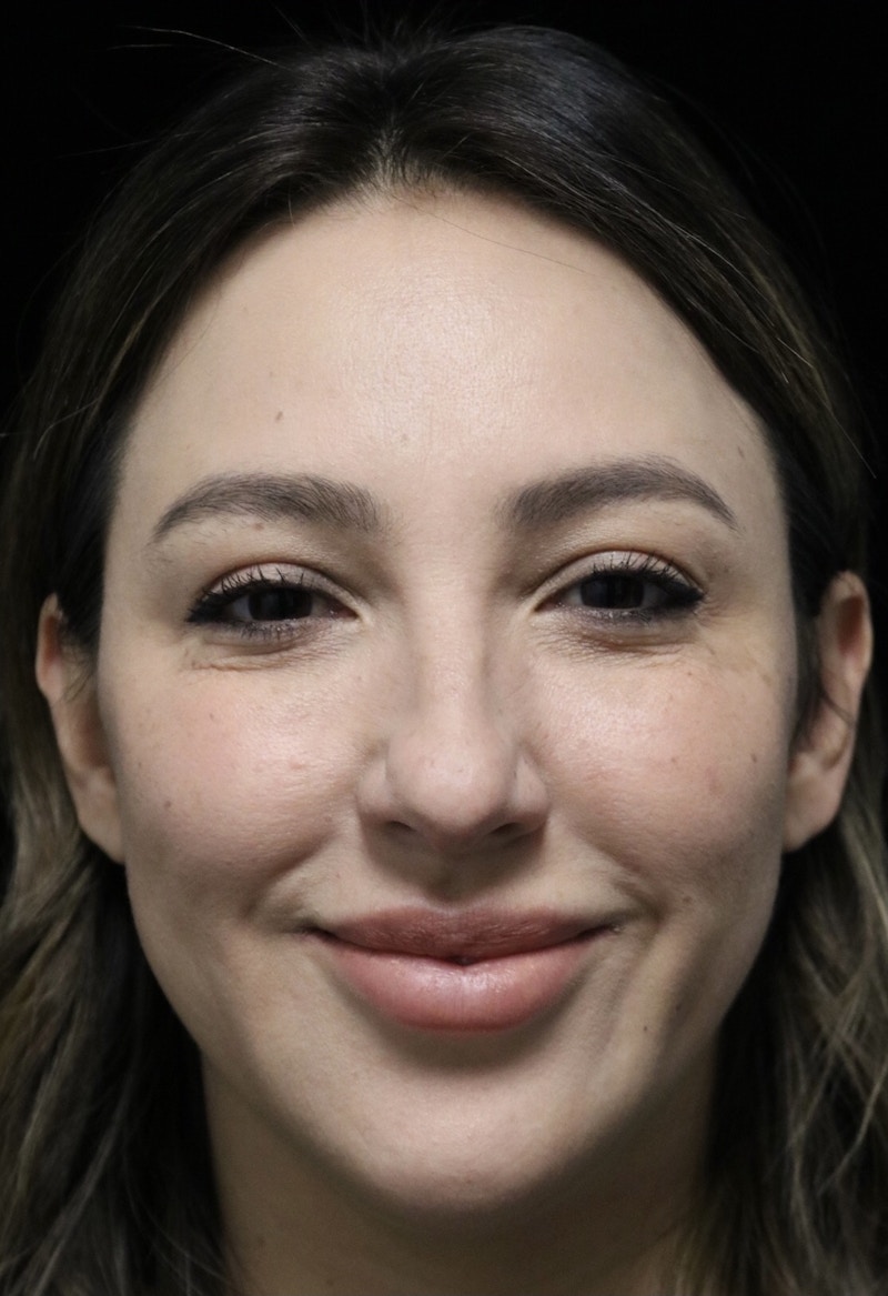 Beverly Hills Rhinoplasty Before & After Gallery - Patient 154581 - Image 5 Dr. Deepak Raj Dugar