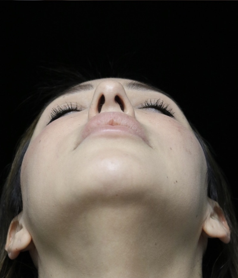 Beverly Hills Rhinoplasty Before & After Gallery - Patient 154581 - Image 8 Dr. Deepak Raj Dugar
