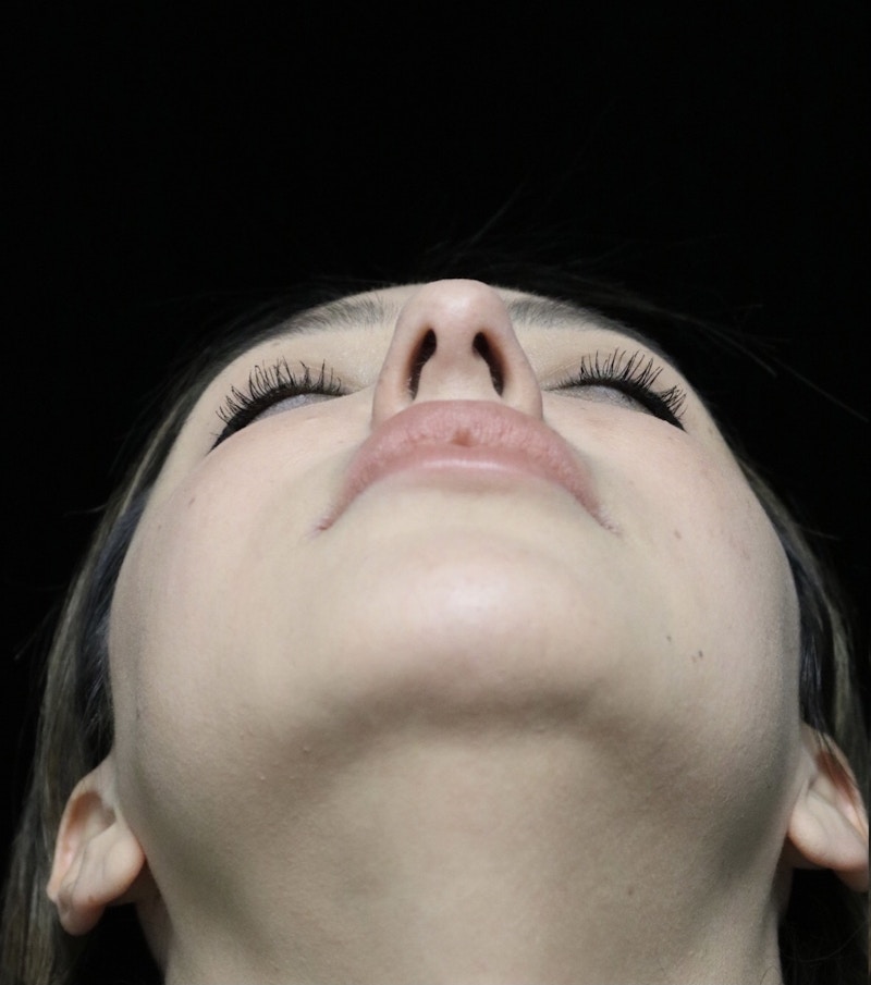Beverly Hills Rhinoplasty Before & After Gallery - Patient 154581 - Image 7 Dr. Deepak Raj Dugar