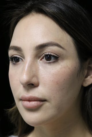 Beverly Hills Rhinoplasty Before & After Gallery - Patient 154581 - Image 10 Dr. Deepak Raj Dugar