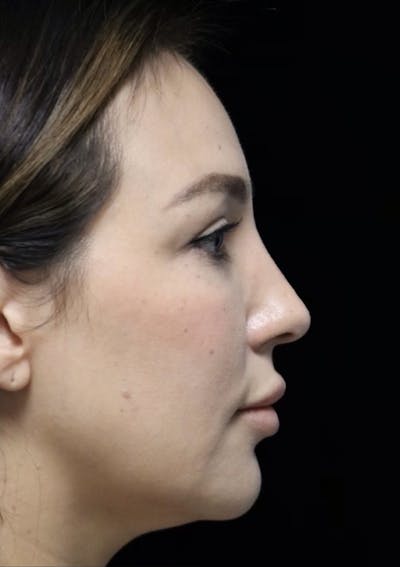 Beverly Hills Rhinoplasty Before & After Gallery - Patient 154581 - Image 2 Dr. Deepak Raj Dugar