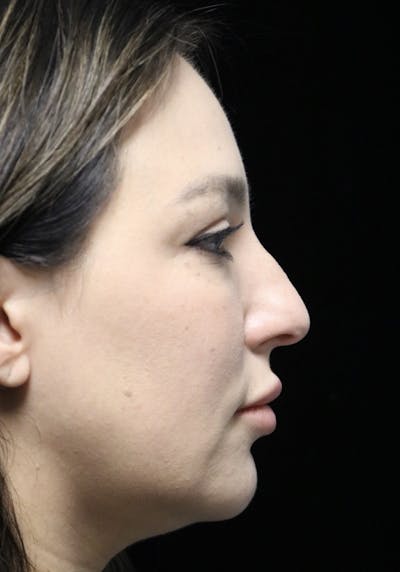 Beverly Hills Rhinoplasty Before & After Gallery - Patient 154581 - Image 1 Dr. Deepak Raj Dugar