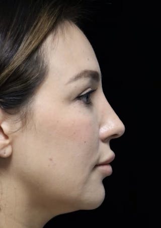 Beverly Hills Rhinoplasty Before & After Gallery - Patient 154581 - Image 12 Dr. Deepak Raj Dugar