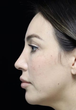 Beverly Hills Rhinoplasty Before & After Gallery - Patient 154581 - Image 14 Dr. Deepak Raj Dugar