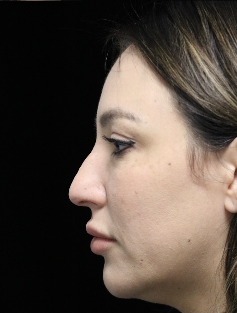 Beverly Hills Rhinoplasty Before & After Gallery - Patient 154581 - Image 13 Dr. Deepak Raj Dugar