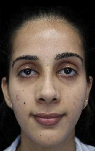 Beverly Hills Rhinoplasty Before & After Gallery - Patient 149686 - Image 4 Dr. Deepak Raj Dugar