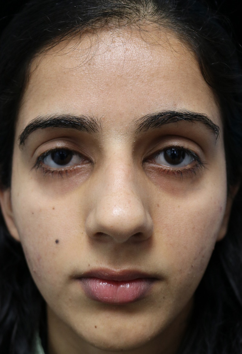 Beverly Hills Rhinoplasty Before & After Gallery - Patient 149686 - Image 3 Dr. Deepak Raj Dugar