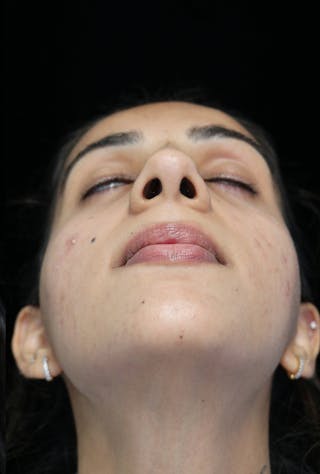 Beverly Hills Rhinoplasty Before & After Gallery - Patient 149686 - Image 6 Dr. Deepak Raj Dugar