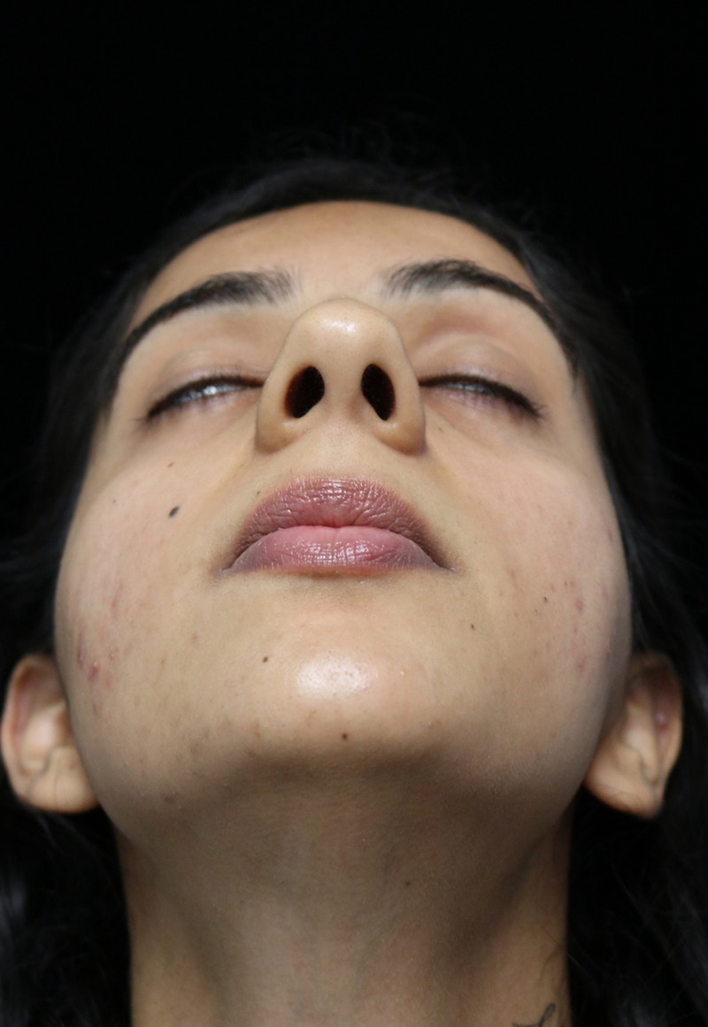 Beverly Hills Rhinoplasty Before & After Gallery - Patient 149686 - Image 5 Dr. Deepak Raj Dugar