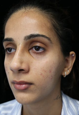 Beverly Hills Rhinoplasty Before & After Gallery - Patient 149686 - Image 8 Dr. Deepak Raj Dugar