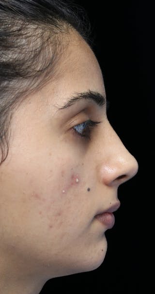 Beverly Hills Rhinoplasty Before & After Gallery - Patient 149686 - Image 2 Dr. Deepak Raj Dugar