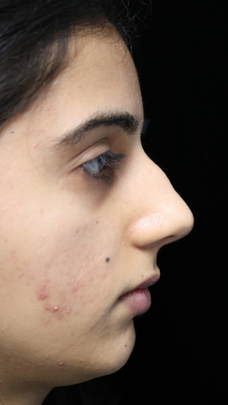 Beverly Hills Rhinoplasty Before & After Gallery - Patient 149686 - Image 1 Dr. Deepak Raj Dugar