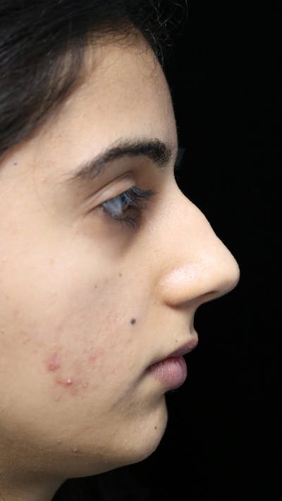 Beverly Hills Rhinoplasty Before & After Gallery - Patient 149686 - Image 1 Dr. Deepak Raj Dugar