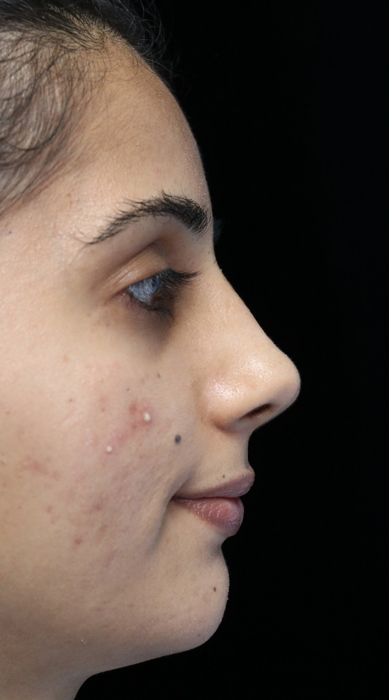 Beverly Hills Rhinoplasty Before & After Gallery - Patient 149686 - Image 10 Dr. Deepak Raj Dugar