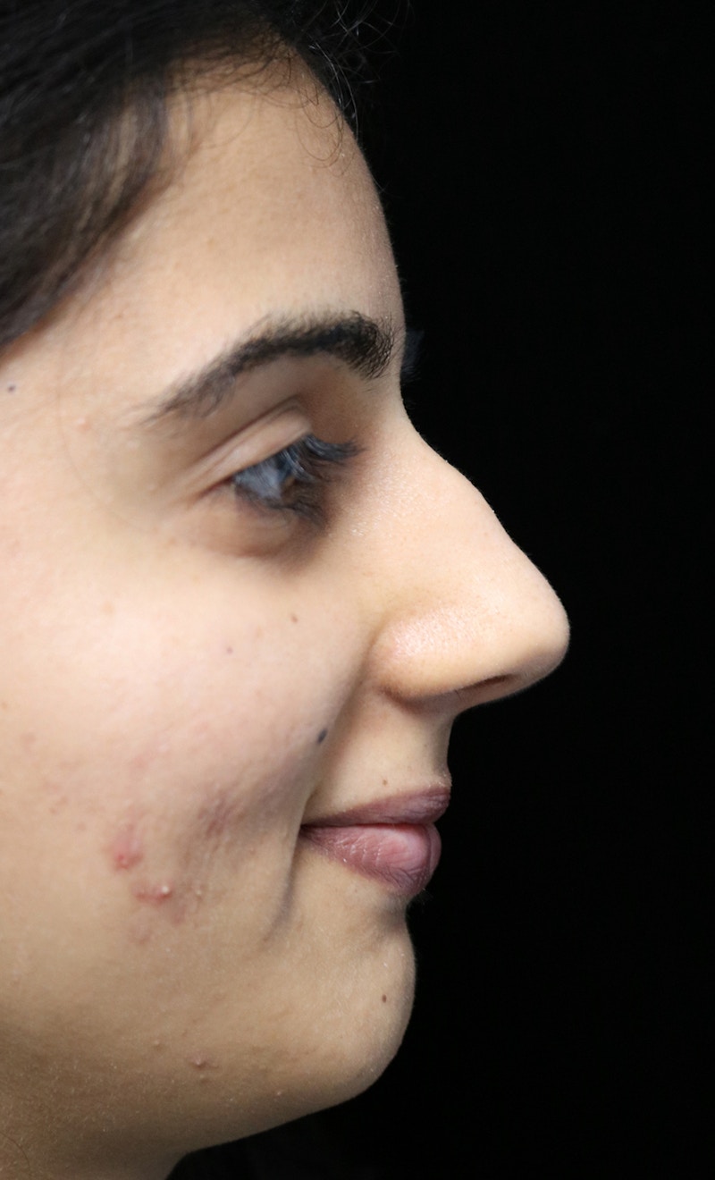 Beverly Hills Rhinoplasty Before & After Gallery - Patient 149686 - Image 9 Dr. Deepak Raj Dugar