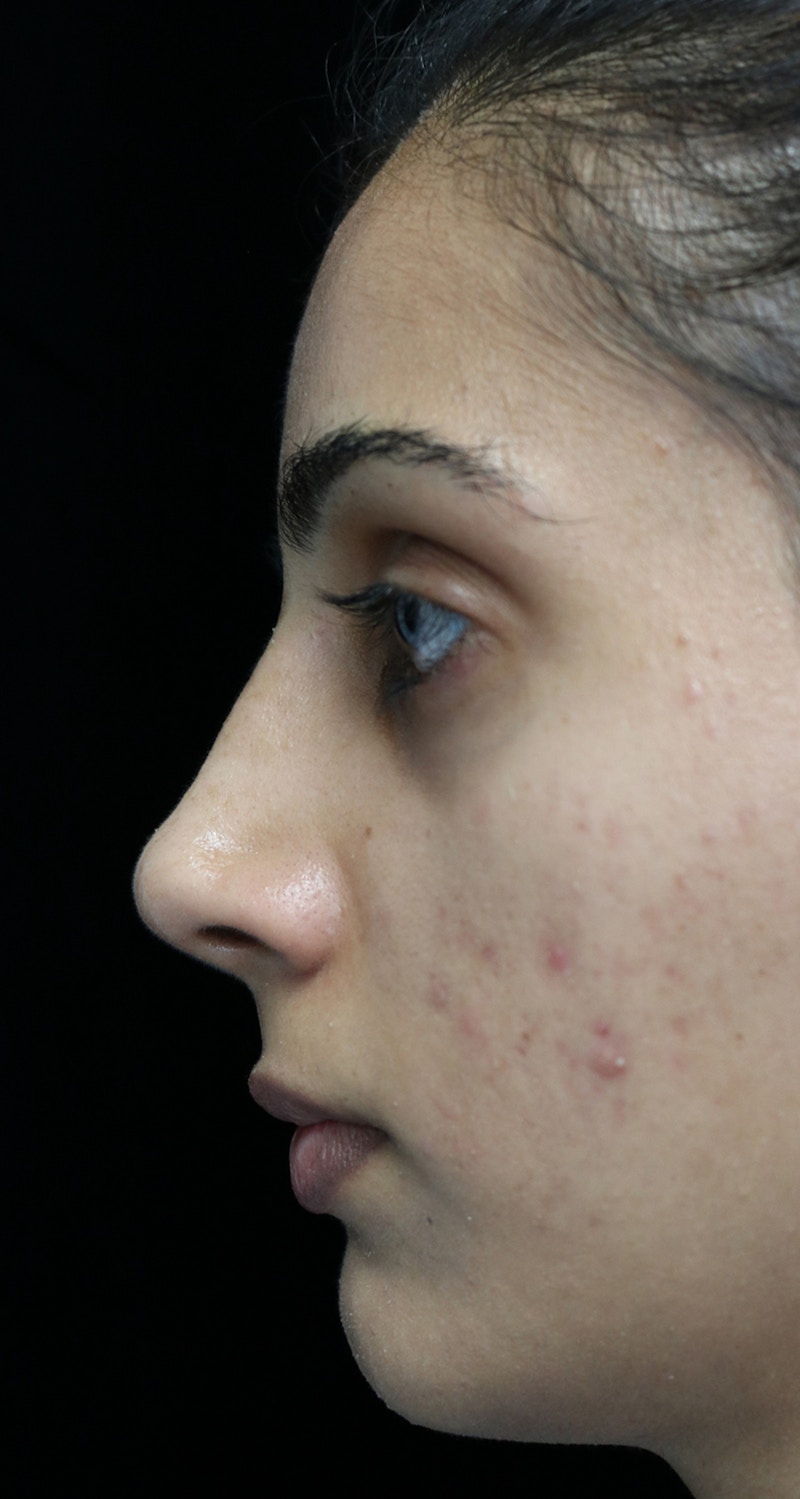 Beverly Hills Rhinoplasty Before & After Gallery - Patient 149686 - Image 12 Dr. Deepak Raj Dugar