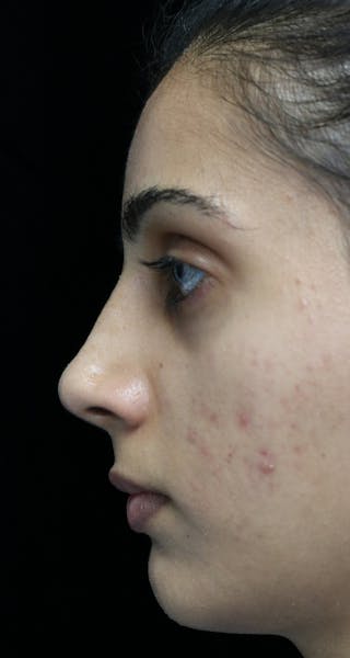 Beverly Hills Rhinoplasty Before & After Gallery - Patient 149686 - Image 12 Dr. Deepak Raj Dugar