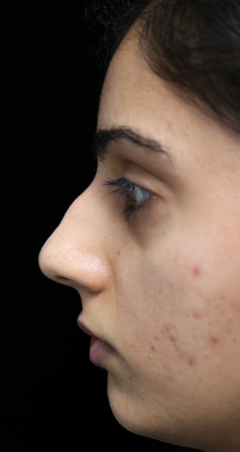 Beverly Hills Rhinoplasty Before & After Gallery - Patient 149686 - Image 11 Dr. Deepak Raj Dugar
