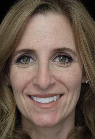 Beverly Hills Rhinoplasty Before & After Gallery - Patient 489862 - Image 4 Dr. Deepak Raj Dugar