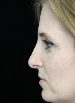 Beverly Hills Rhinoplasty Before & After Gallery - Patient 489862 - Image 6 Dr. Deepak Raj Dugar