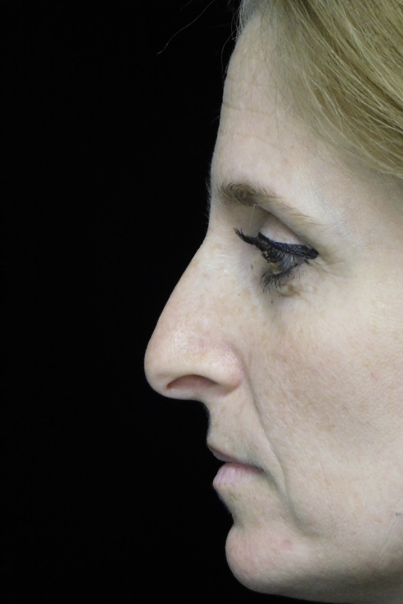 Beverly Hills Rhinoplasty Before & After Gallery - Patient 489862 - Image 5 Dr. Deepak Raj Dugar