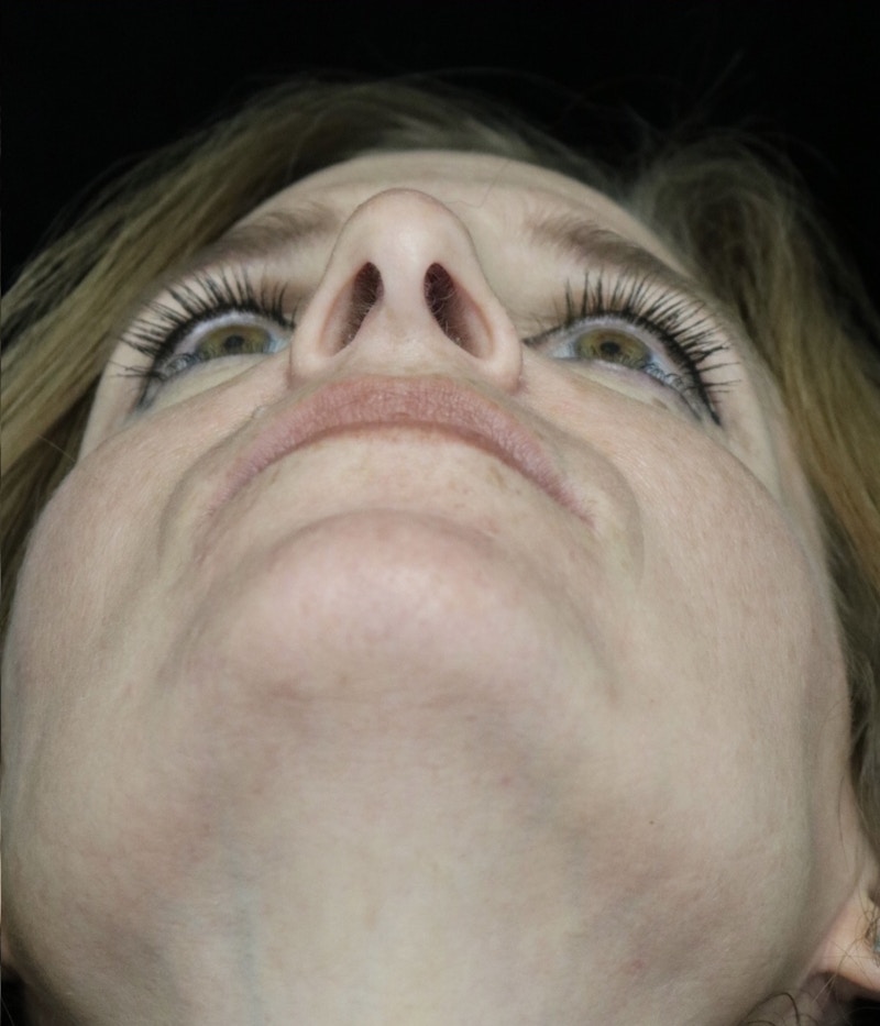 Beverly Hills Rhinoplasty Before & After Gallery - Patient 489862 - Image 8 Dr. Deepak Raj Dugar
