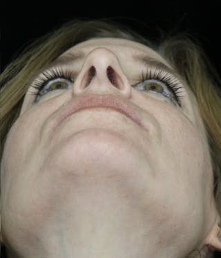 Beverly Hills Rhinoplasty Before & After Gallery - Patient 489862 - Image 8 Dr. Deepak Raj Dugar