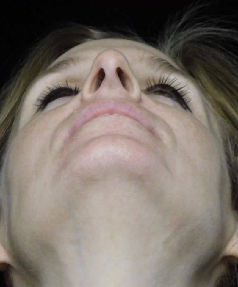 Beverly Hills Rhinoplasty Before & After Gallery - Patient 489862 - Image 7 Dr. Deepak Raj Dugar