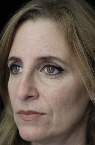 Beverly Hills Rhinoplasty Before & After Gallery - Patient 489862 - Image 10 Dr. Deepak Raj Dugar